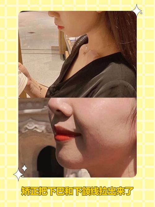 牙齿矫正还是美容冠-图1