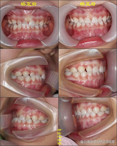 南京牙齿矫正便宜的靠谱吗？-图3