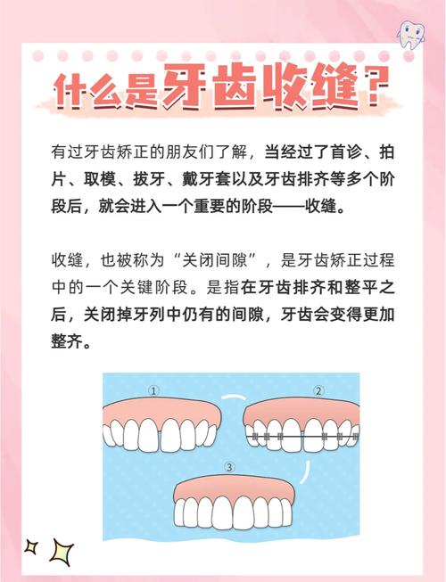 矫正牙齿牙缝要多久-图2