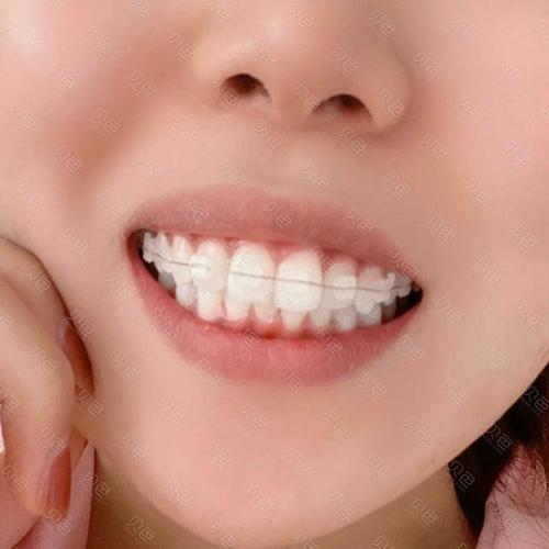 陶瓷半隐形矫正，隐形效果与舒适度到底如何？-图1