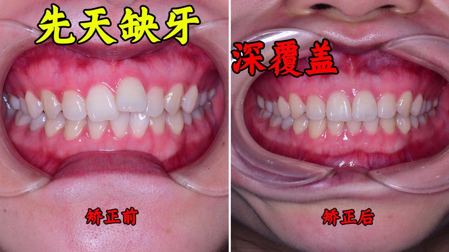 缺一颗牙能做牙齿矫正吗？效果会受影响吗？-图2