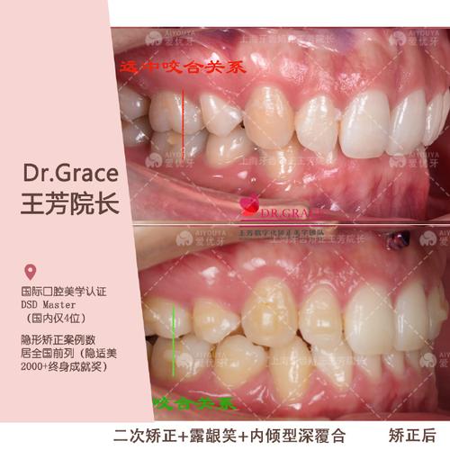 上海矫正牙齿效果如何？体验好不好？-图2