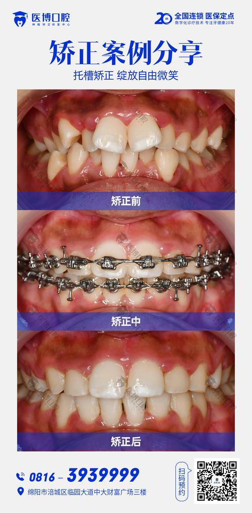 牙齿矫正的变化图片-图3