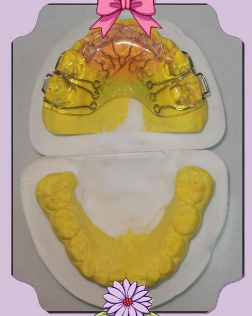 儿童牙齿活动矫正器效果如何？使用安全吗？-图1