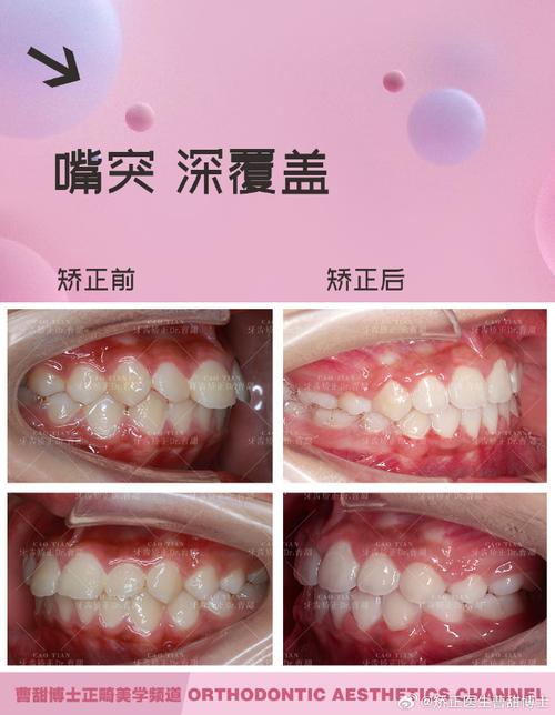 西安哪里矫正牙齿好-图2