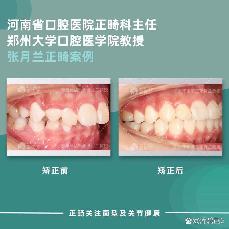 郑州矫正牙齿哪里好-图1