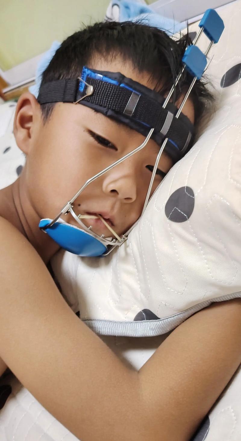 牙齿地包天如何矫正-图2