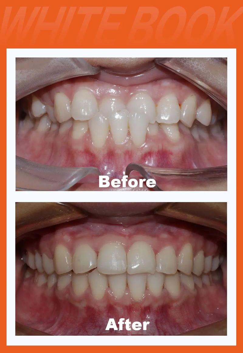 成人牙齿还能矫正吗-图1