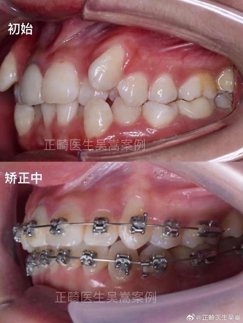 南京矫正牙齿哪家好-图1