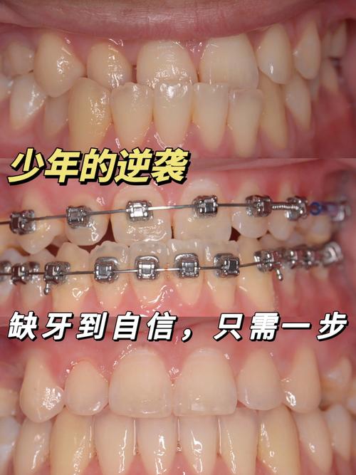 有蛀牙可以矫正牙齿-图3