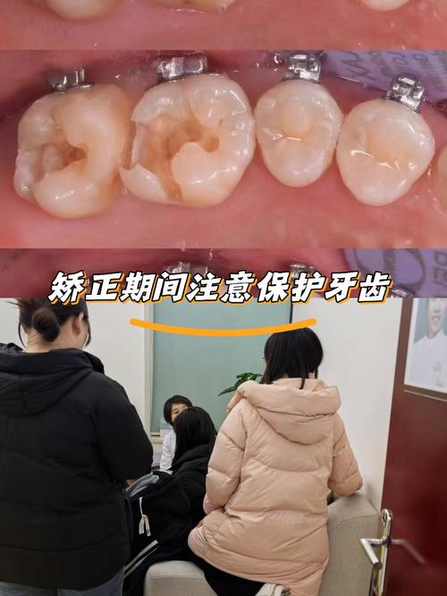 有蛀牙可以矫正牙齿-图1