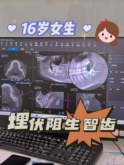 牙齿矫正智齿要拔吗-图2