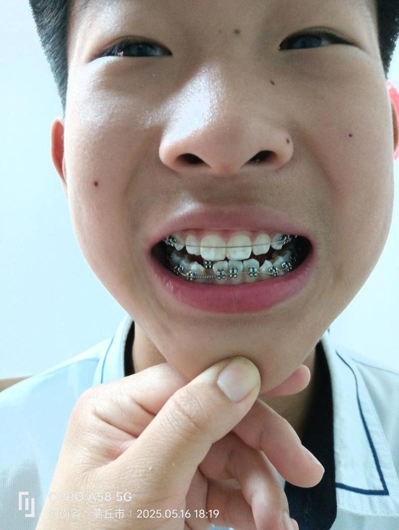 22岁矫正牙齿晚不晚?还有年龄限制吗?-图3 22岁矫正牙齿晚不晚?还有年龄限制吗?-图3