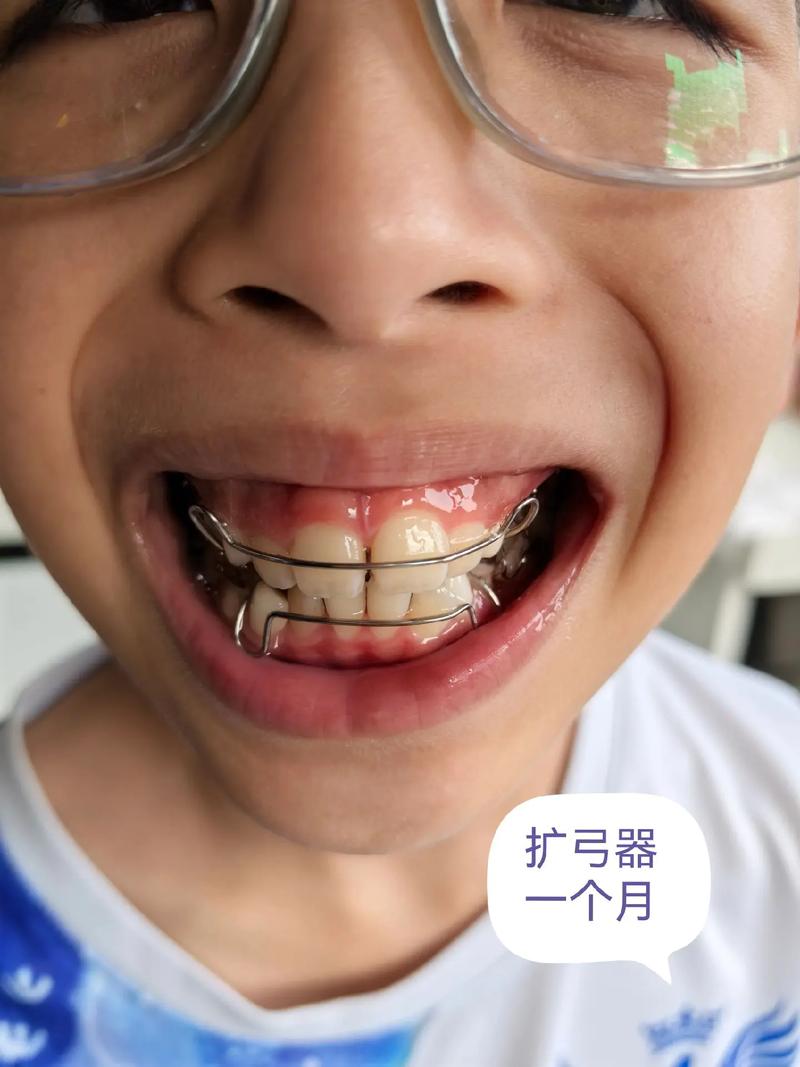 22岁矫正牙齿晚不晚?还有年龄限制吗?-图1 22岁矫正牙齿晚不晚?还有年龄限制吗?-图1