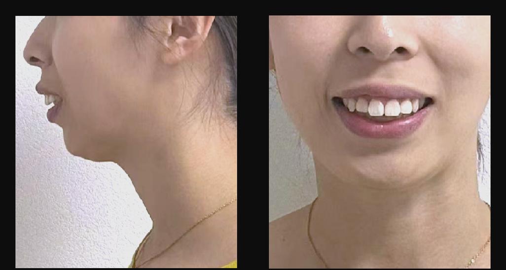 28岁矫正牙齿还来得及吗？现在开始晚不晚？效果会受年龄影响吗？-图1