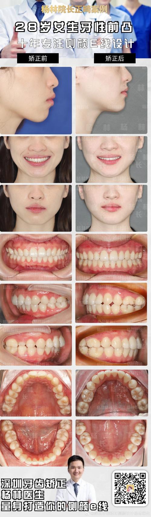 28岁矫正牙齿还来得及吗？现在开始晚不晚？效果会受年龄影响吗？-图2
