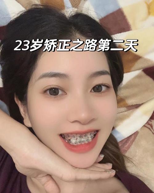 23岁可以矫正牙齿-图3