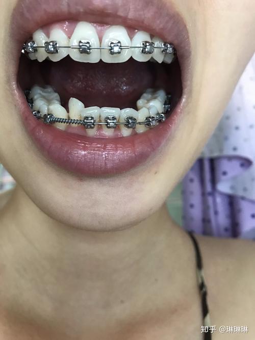 23岁可以矫正牙齿-图2