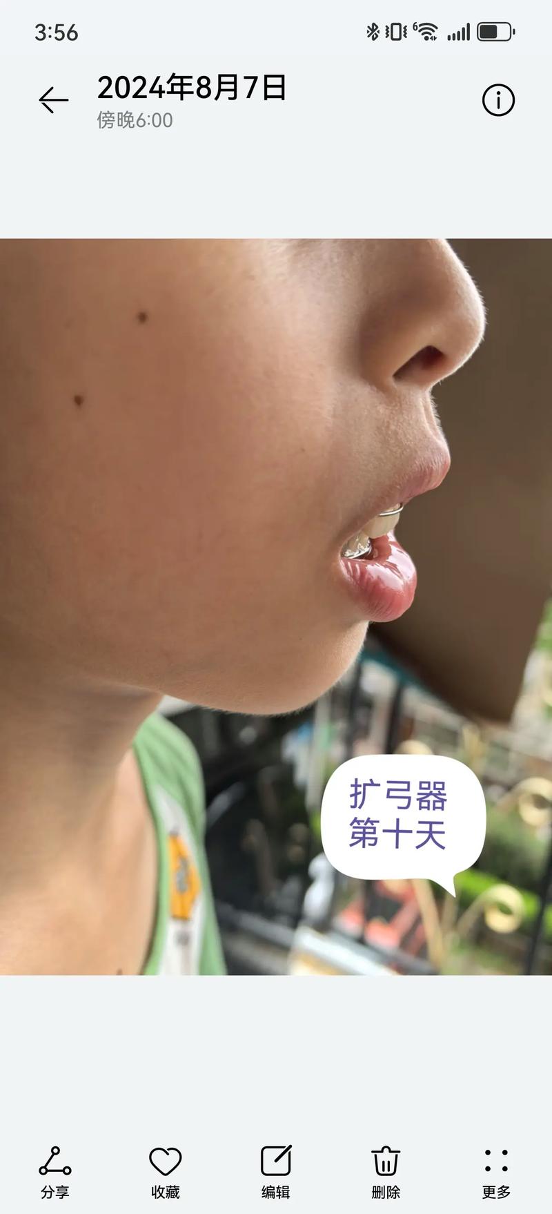 26岁矫正牙齿还来得及吗？会不会太晚？-图2