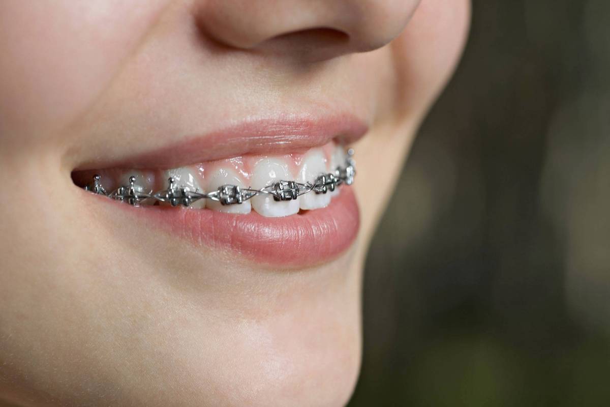 25岁矫正牙齿还来得及吗？成年人矫正牙齿有年龄限制吗？-图2