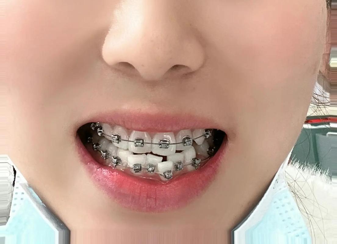 成人拔牙矫正，是否必须拔牙？效果与风险有哪些需要注意的？-图1