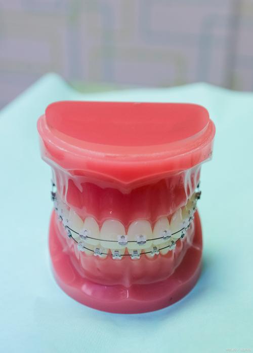 金属托槽矫正牙齿效果如何？优缺点有哪些？-图3