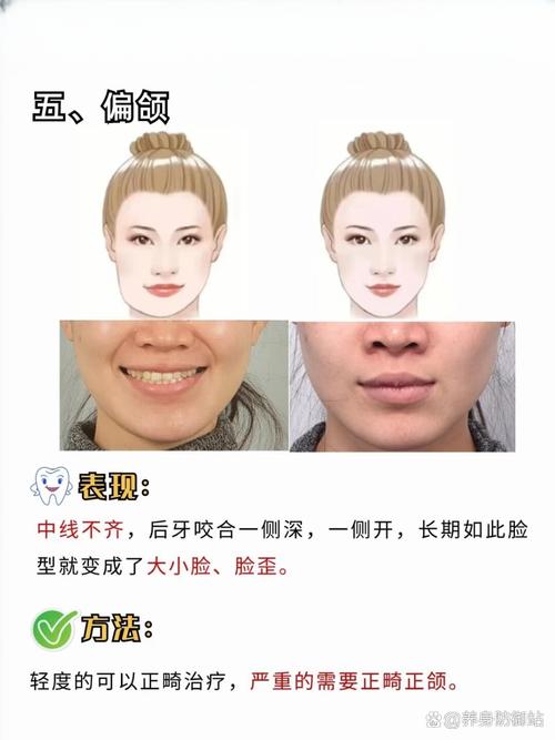 矫正牙齿改变脸型？是真是假？真相如何？-图2