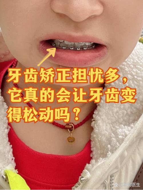 牙齿矫正会让牙齿松动吗？-图1