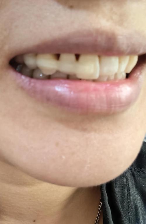 牙齿矫正会让牙齿松动吗？-图3