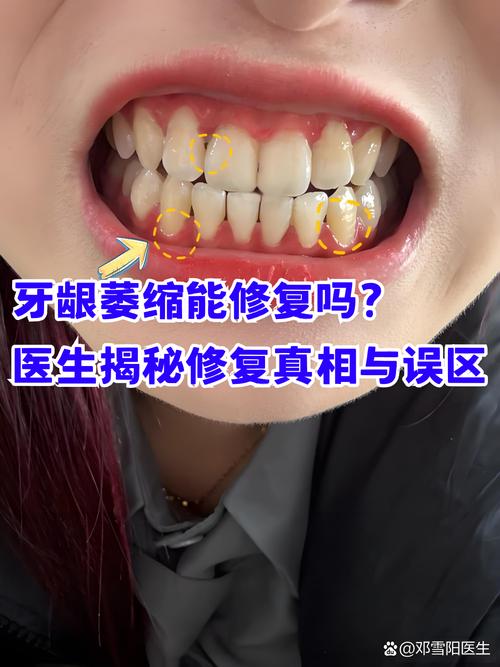 牙齿矫正牙龈萎缩了-图1