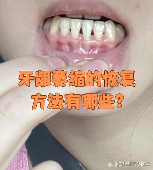 牙齿矫正牙龈萎缩了-图2