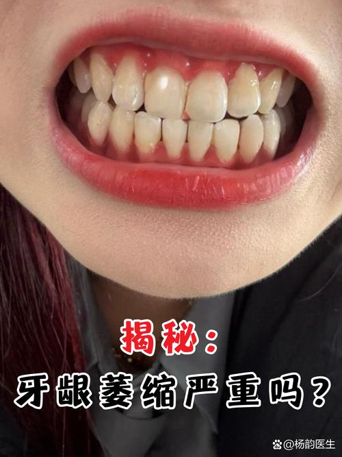 牙齿矫正会导致牙龈萎缩吗？如何避免这种情况发生？-图3