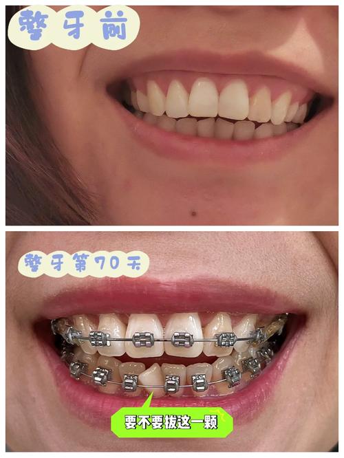 牙齿矫正为何只拔一颗？一颗的拔除对矫正效果影响大吗？-图1