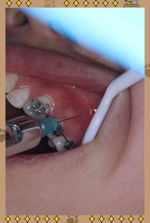 矫正牙齿为何要拔牙？拔牙是必要步骤吗？-图1