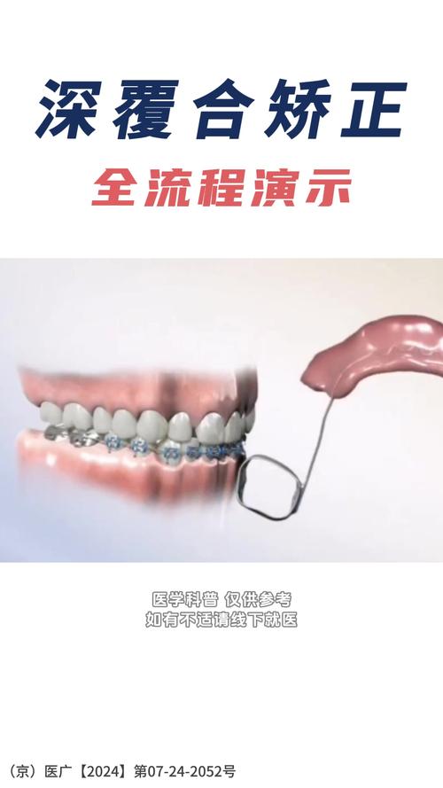 矫正牙齿的过程视频详细记录了哪些矫正步骤？-图1