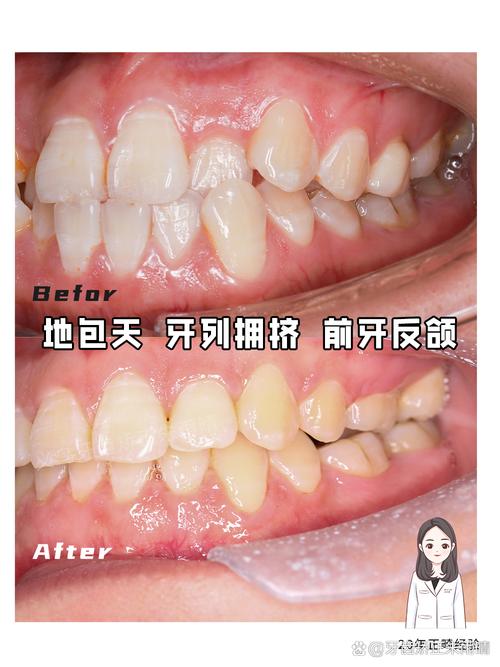 牙齿拥挤矫正哪家好？选靠谱机构要注意这些！-图3