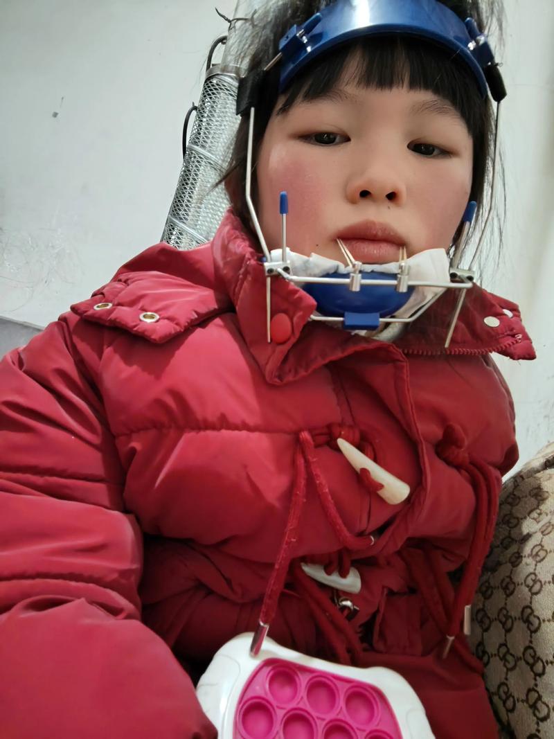 轻微天包地牙齿矫正，有必要做吗？效果如何？-图2