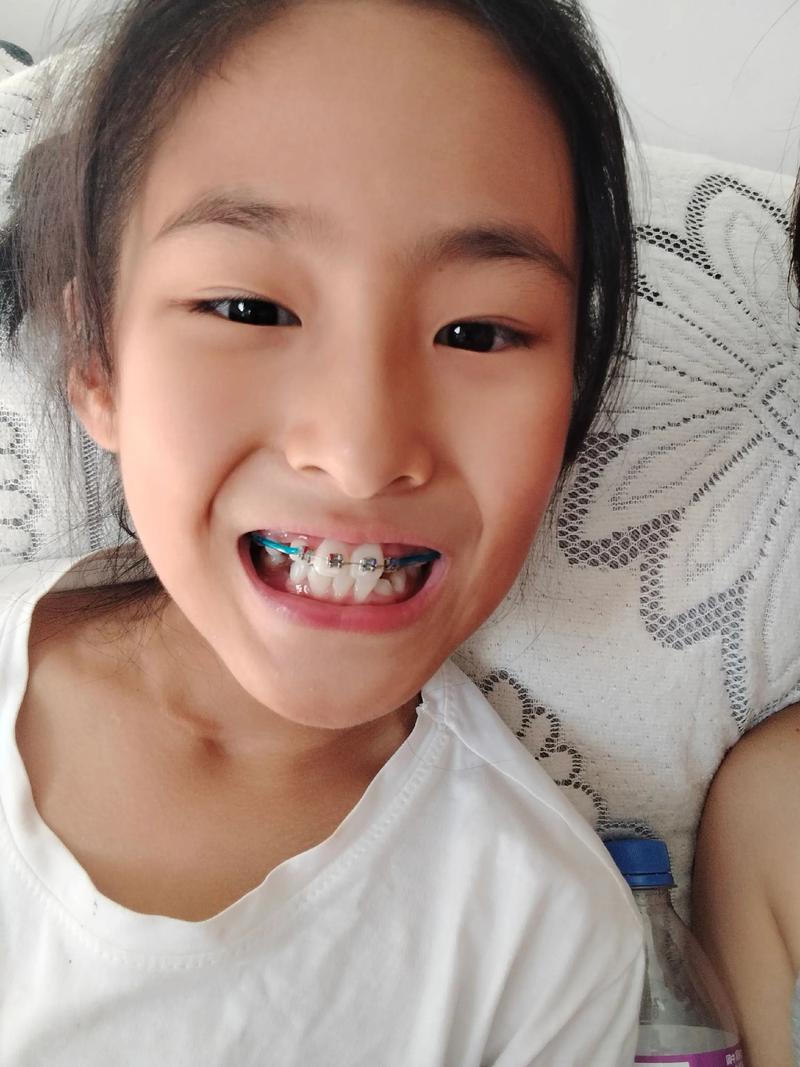 矫正牙齿越早越好？年龄越小矫正效果越佳吗？-图2