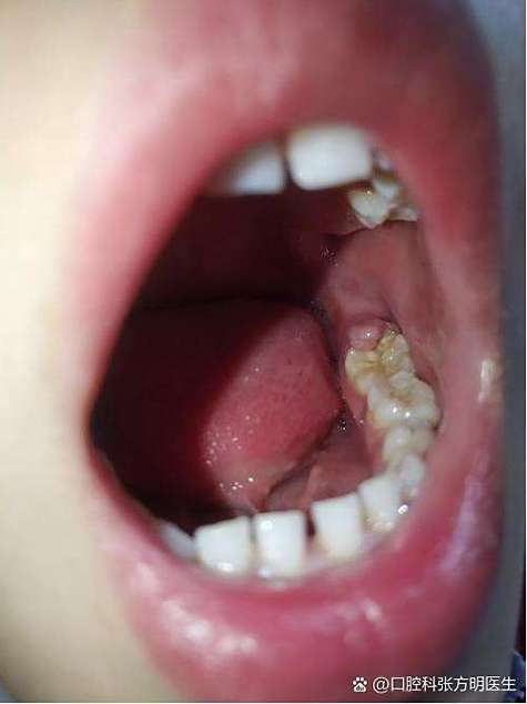 矫正牙齿后牙龈肿痛怎么办？-图2