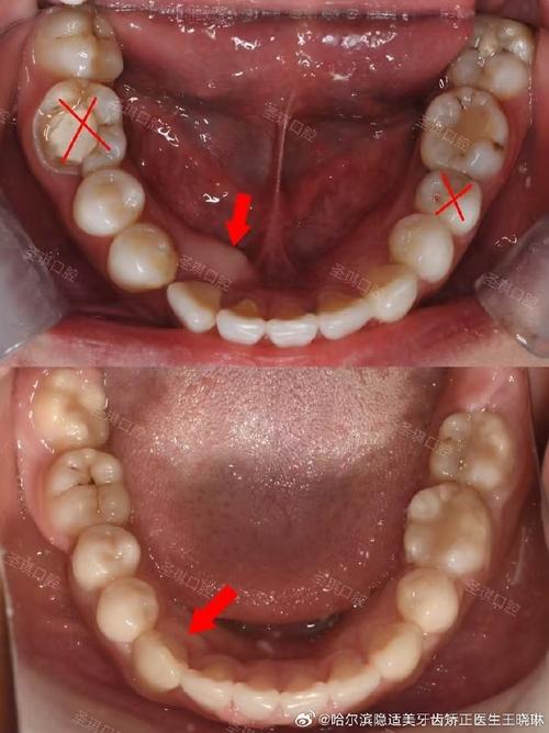 牙齿矫正下牙齿不齐，矫正后没改善怎么办？-图2
