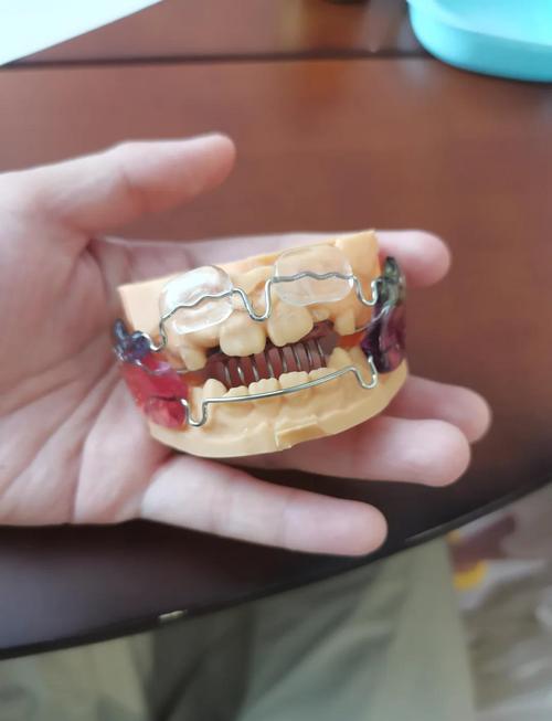 矫正牙齿为何要先戴矫正器？-图1