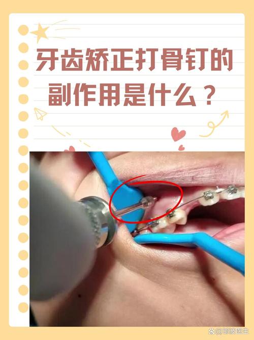 牙齿矫正都要打骨钉吗？什么情况下才需要打？-图1