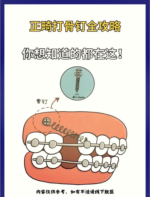 牙齿矫正都要打骨钉吗？什么情况下才需要打？-图2