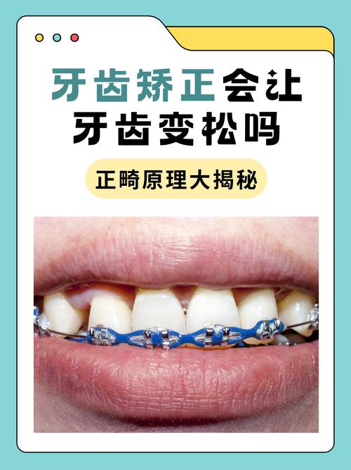 矫正过程中牙齿松动，是正常现象还是异常信号？-图1