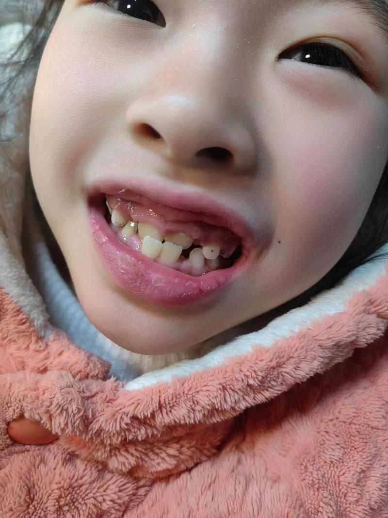 矫正牙齿不用戴牙套？怎么做到的？-图3