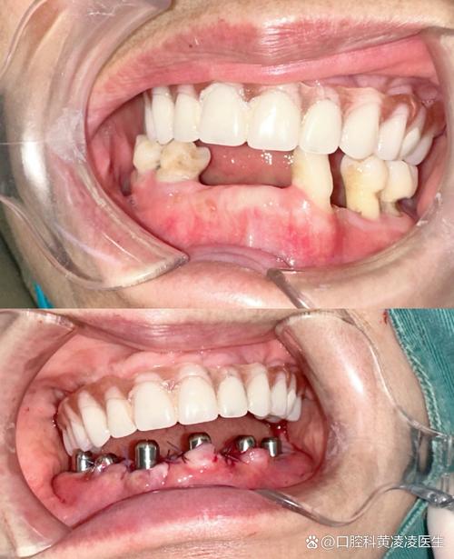 拔牙矫正后牙齿松动，是正常现象还是异常信号？-图1