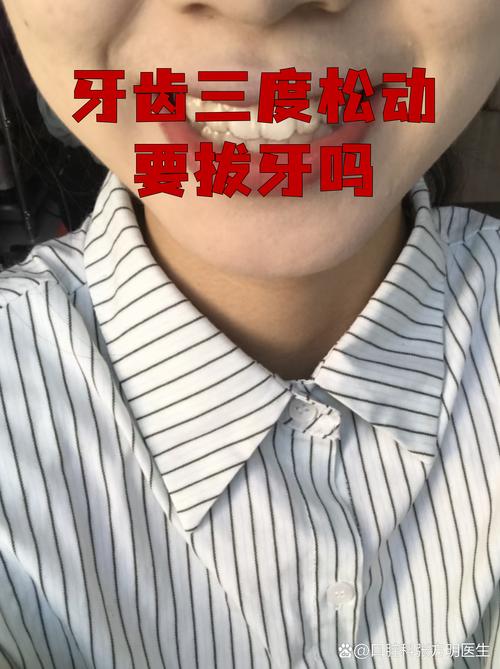 拔牙矫正后牙齿松动，是正常现象还是异常信号？-图3