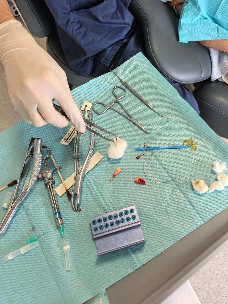 矫正拔牙疼不疼？过程会很难受吗？-图1