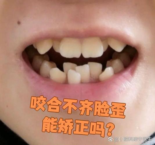 矫正牙齿脸型会变丑吗？矫正过程脸型变化会影响颜值吗？-图2