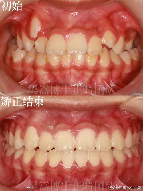 虎牙不拔牙矫正牙齿-图1
